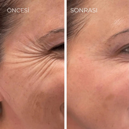EsilaCare™ Medikal Silikonlu Kolajen Bandı | Kırışıklık ve Yara İzi Bakım Bandı 4 cm x 1,5 m